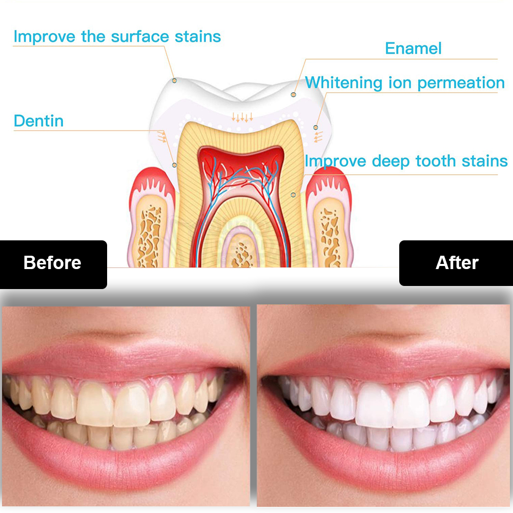 Dental Teeth Whitening Kit Min – Teeth Whitening Gel Syringes recenzja i cena
