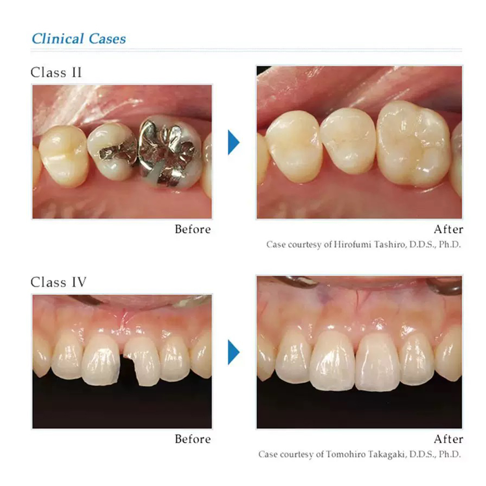 Dental Restorative Nano Compos – Teeth Whitening Opalescence recenzja i cena