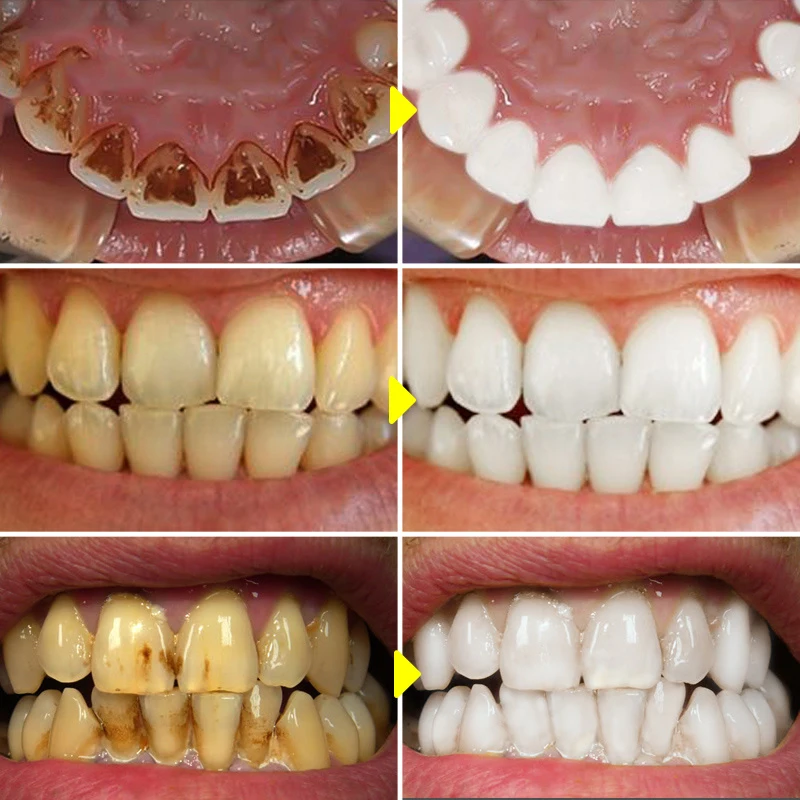 V34 Teeth Whitening Mousse Too – Teeth Whitening Xylitol recenzja i cena