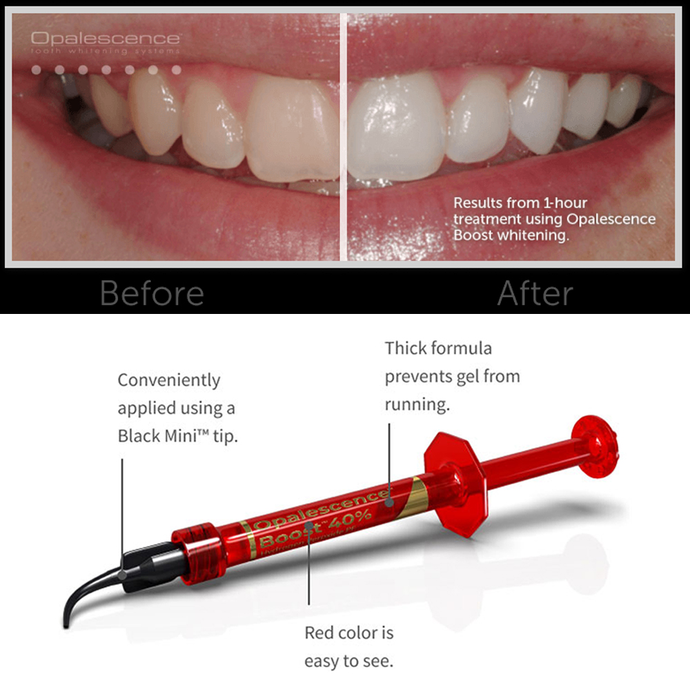 Ultradent Opalescence Boost PF – Teeth Whitening Opalescence recenzja i cena